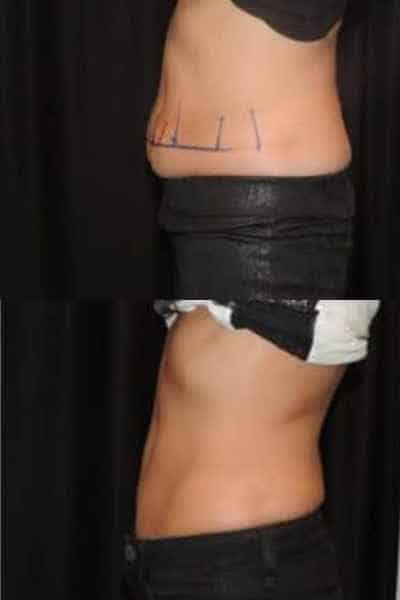 HIEMT Muscle Toning West Bromwich