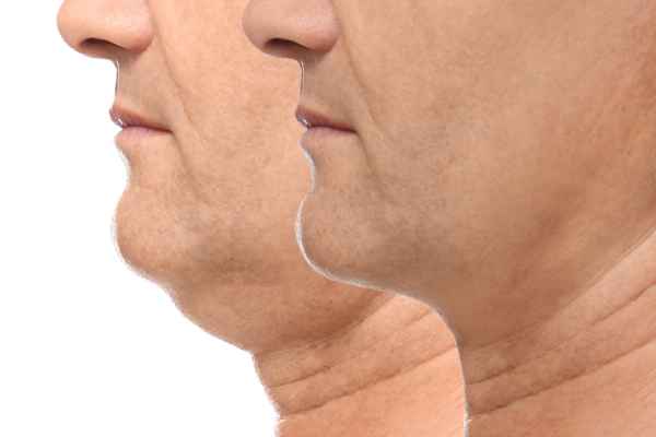 HIFU - Breakthrough in Anti - ageing 2 hifu results West Bromwich