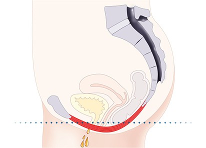 Pelvic-Floor Muscle Repair 5 Pelvic floor muscles West Bromwich