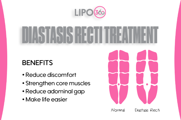 Revolutionising Muscle Repair: The Power of LIPO360 Body Sculpt Post-Injury 5 diastasis recti treatment West Bromwich