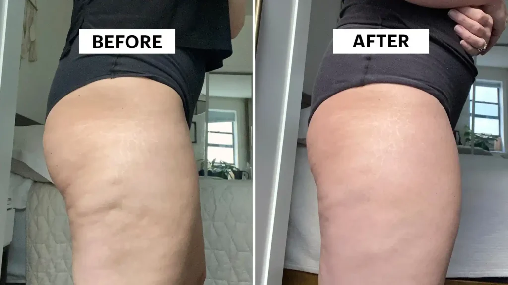 Sculpting Your Bum: Can Toning Exercises Really Reduce Cellulite? 1 Do Toning Exercise West Bromwich Really Tackle Cellulite?