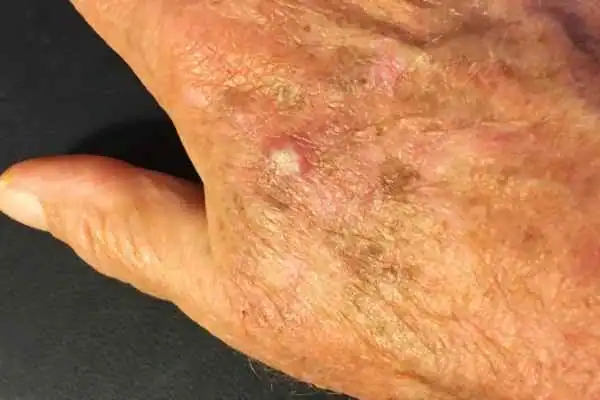 Cryopen For Actinic Keratoses 1 Image of Actinic keratoses West Bromwich on a person hand