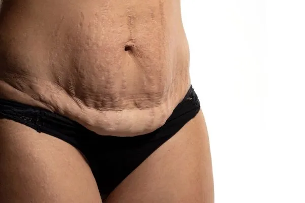 The Science of Skin Tightening 1 The science behind skin tightening West Bromwich picture of a woman's sagging skin on the stomach